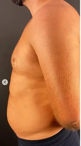 Liposuction, Before