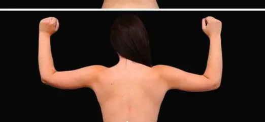 Arm lift, After