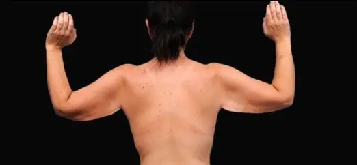 Arm lift, Before