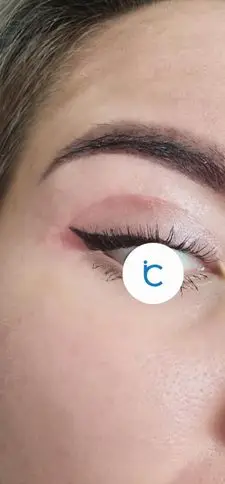 Eyelid surgery, After