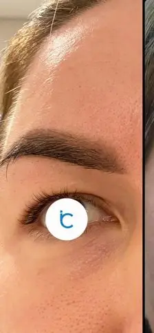 Eyelid surgery, Before