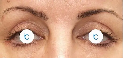 Eyelid surgery, After