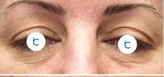 Eyelid surgery, Before