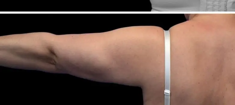 Arm lift, After