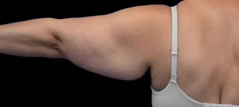 Arm lift, Before