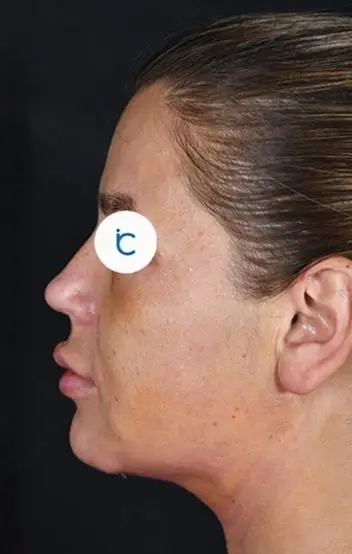 Rhinoplasty, After