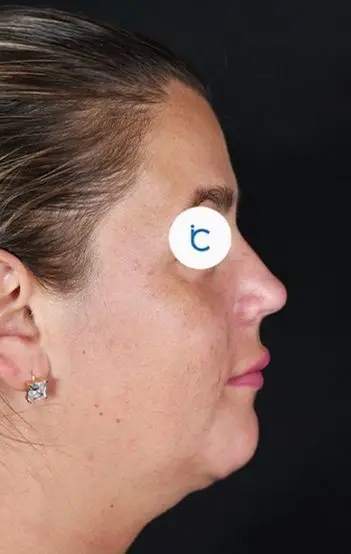 Rhinoplasty, Before