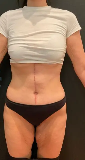 Fleur-de-lis abdominoplasty with Brazilian butt lift, After
