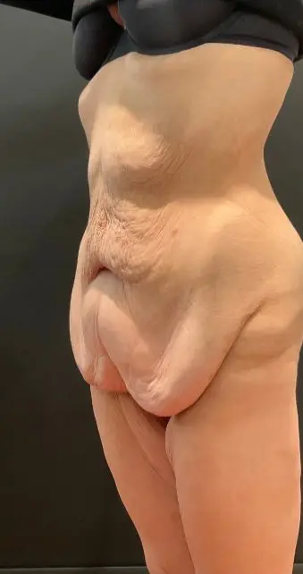 Fleur-de-lis abdominoplasty with buttock lift, Before