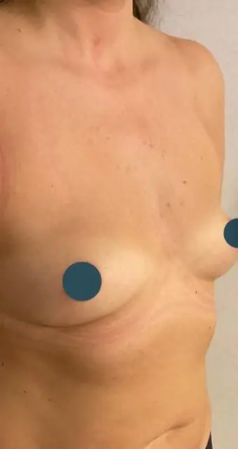 Breast lift with implants, Before