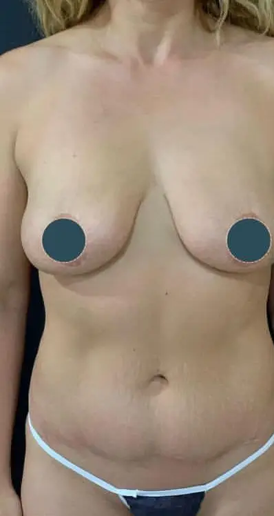 Breast lift, Before