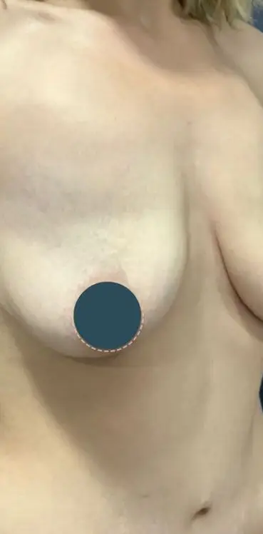 Breast lift, Before
