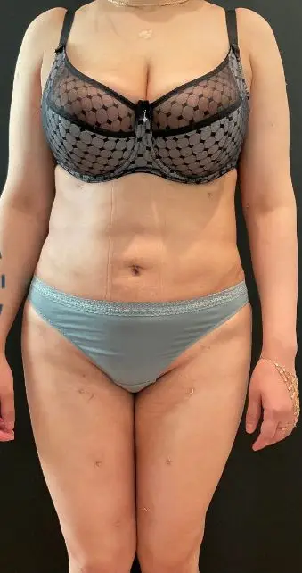 Liposuction with Brazilian butt lift, After