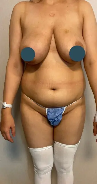 Liposuction with Brazilian butt lift, Before