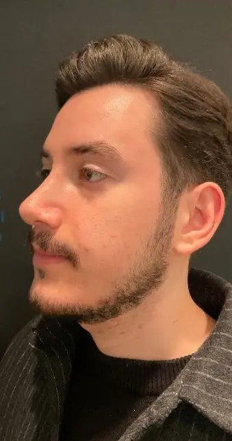 Rhinoplasty, After