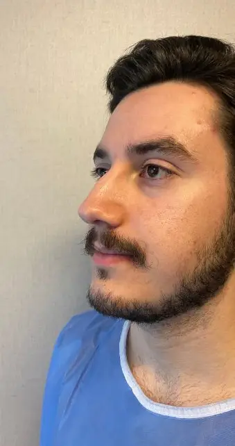Rhinoplasty, Before