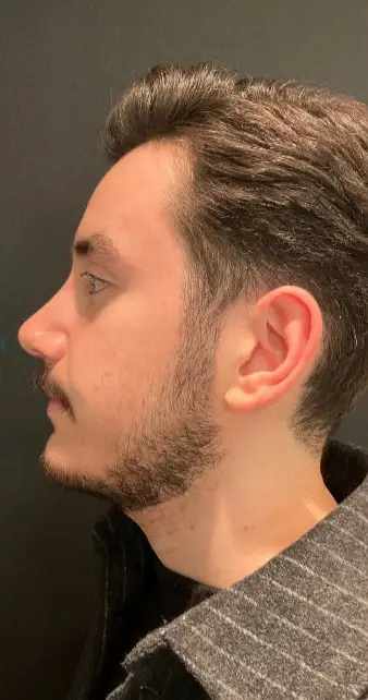 Rhinoplasty, After