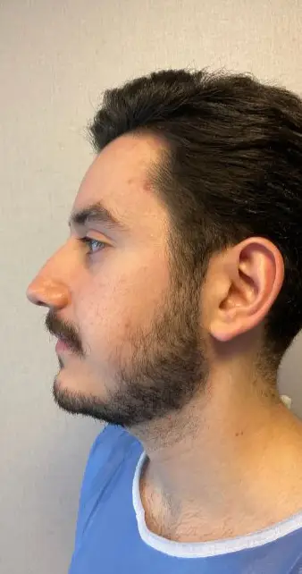 Rhinoplasty, Before