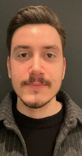Rhinoplasty, After