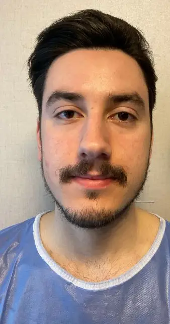Rhinoplasty, Before