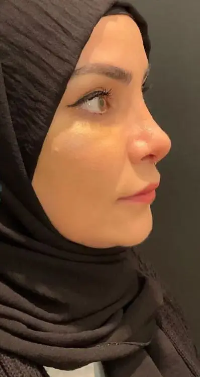 Rhinoplasty, After