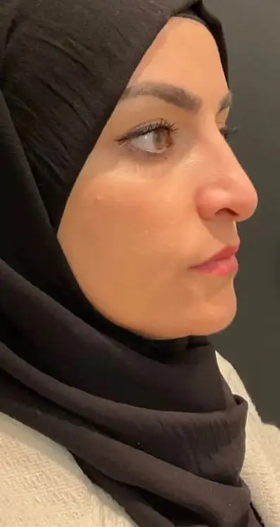 Rhinoplasty, Before