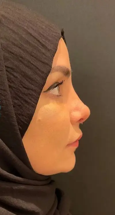 Rhinoplasty, After