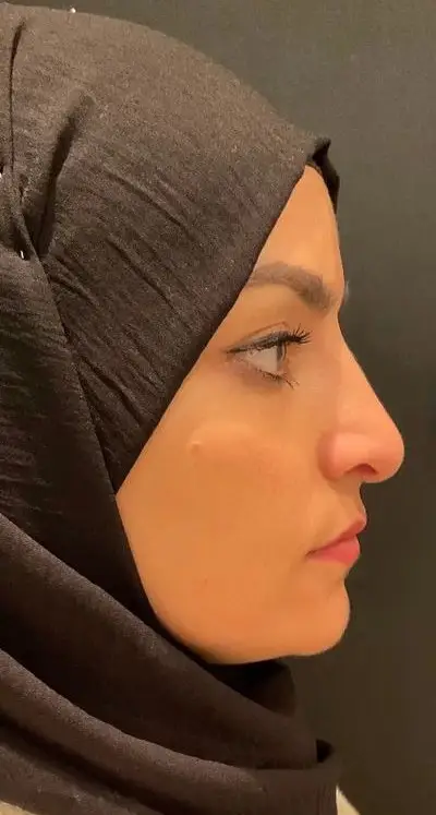 Rhinoplasty, Before