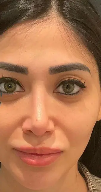 Rhinoplasty, After
