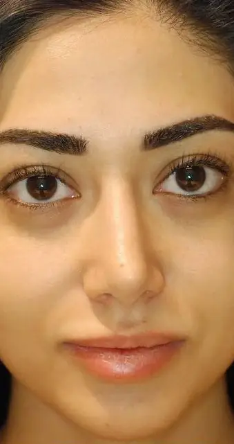 Rhinoplasty, Before