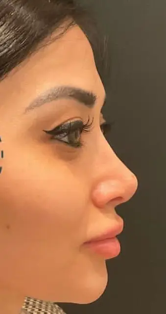 Rhinoplasty, After