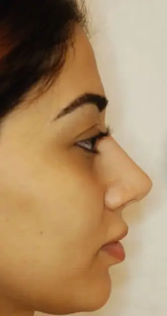 Rhinoplasty, Before