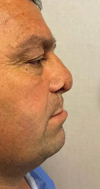 Nasal reconstruction, Before