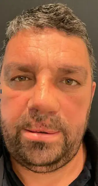 Nasal reconstruction, After