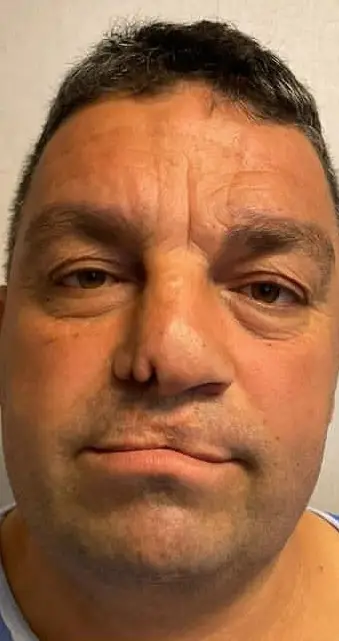 Nasal reconstruction, Before
