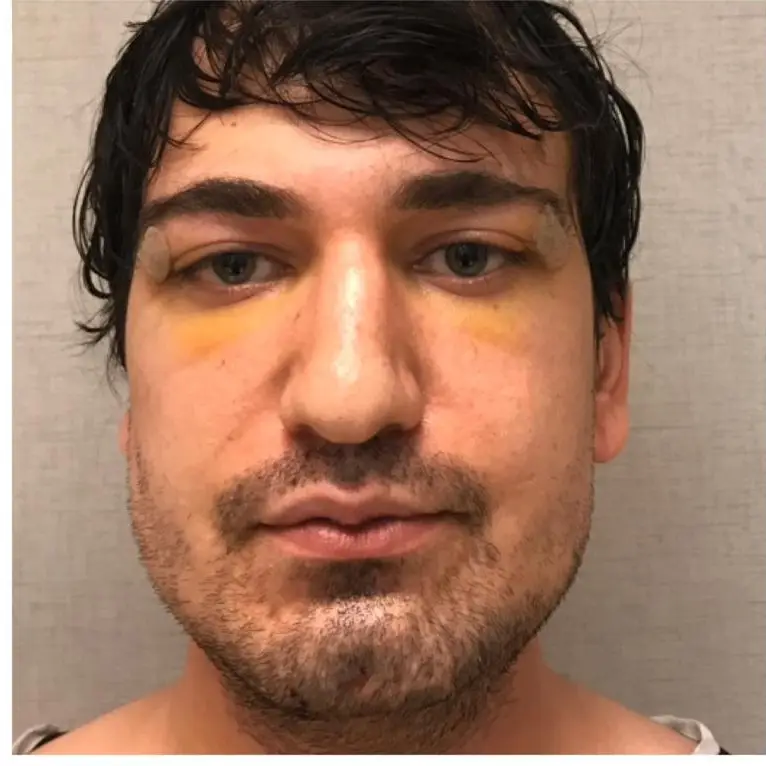 Rhinoplasty, After