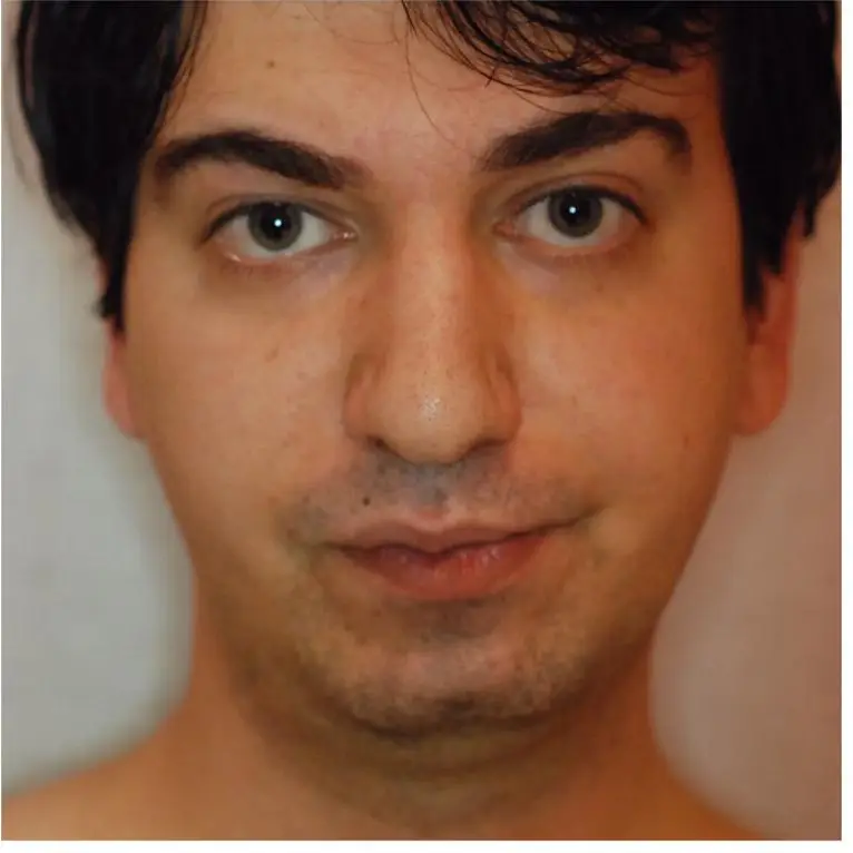Rhinoplasty, Before