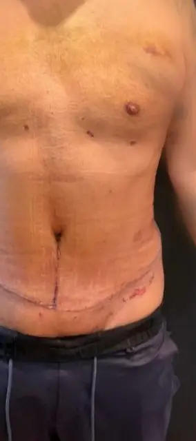 Tummy tuck, After