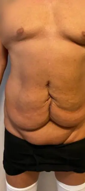 Tummy tuck, Before