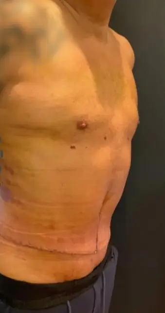 Tummy tuck, After