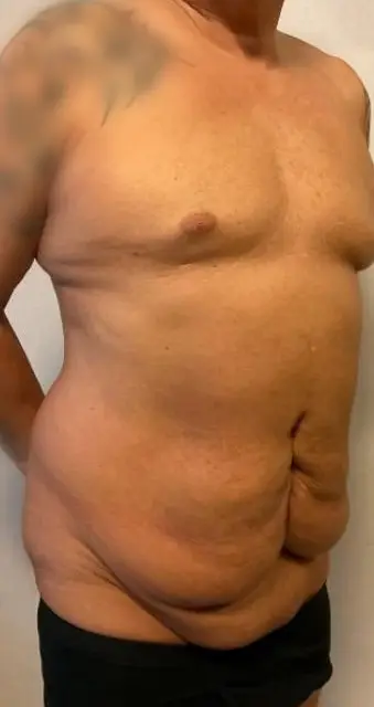 Tummy tuck, Before