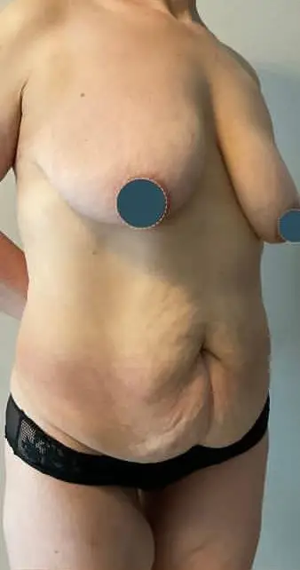 Tummy tuck, Before