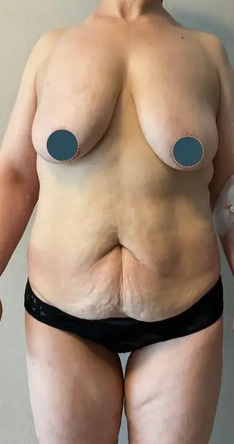 Tummy tuck, Before