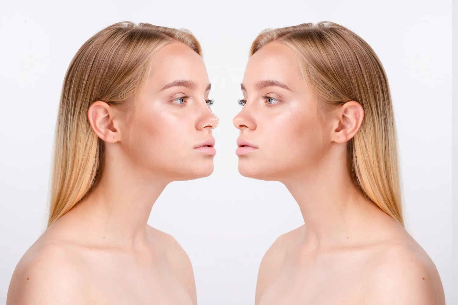 Close-up of a nose in profile during rhinoplasty recovery