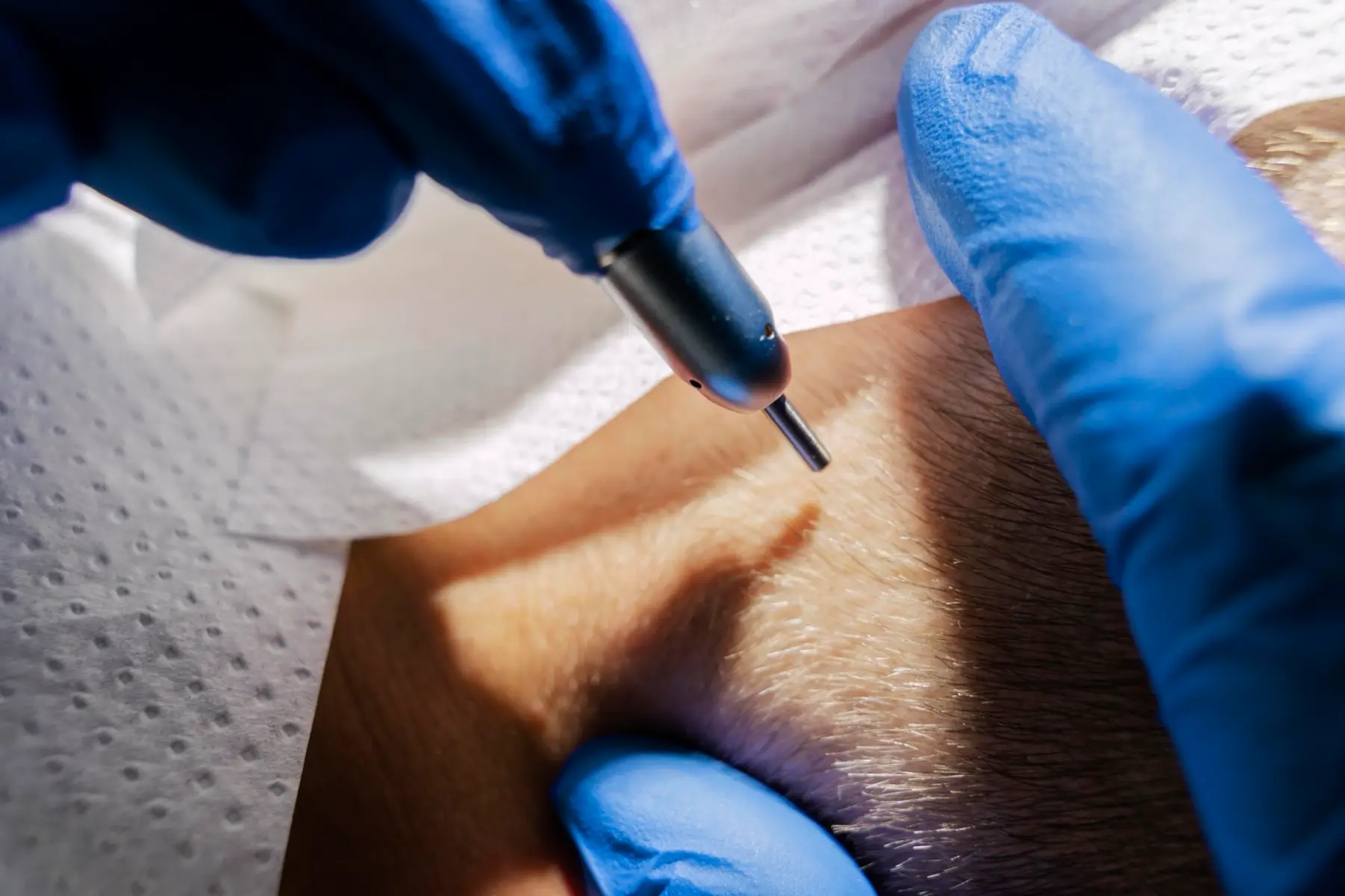 Hair transplant consultation in Istanbul
