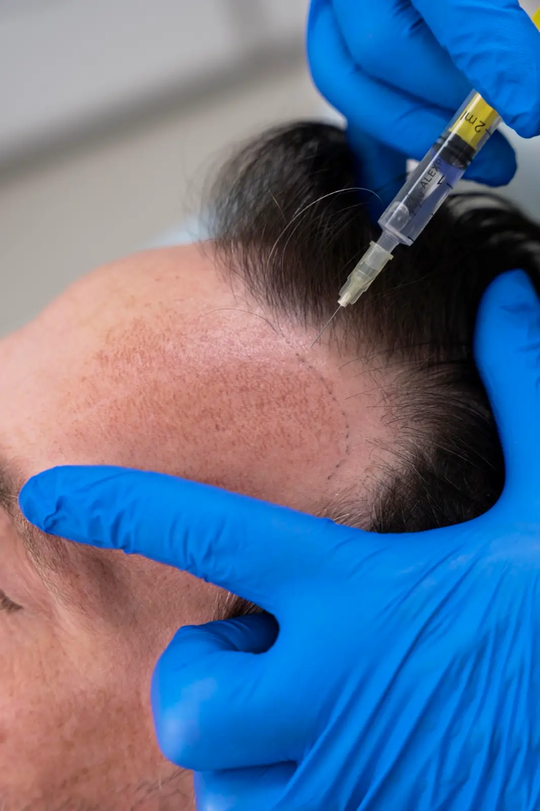 Hair transplant in Turkey