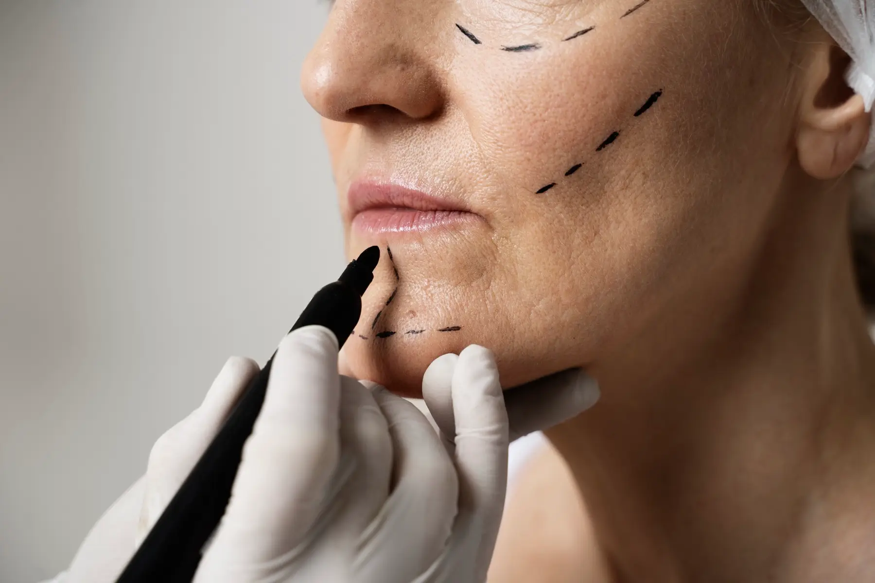 Blepharoplasty (eyelid surgery) consultation in Istanbul