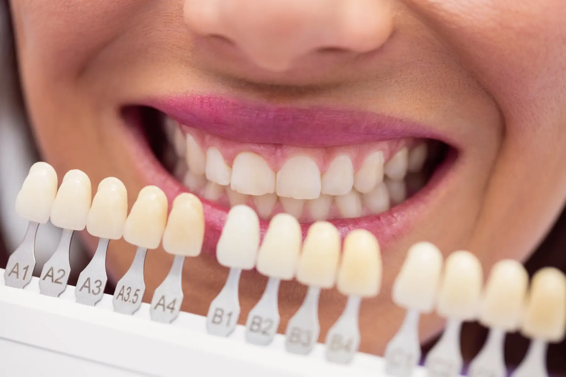 Dental veneers consultation in Istanbul