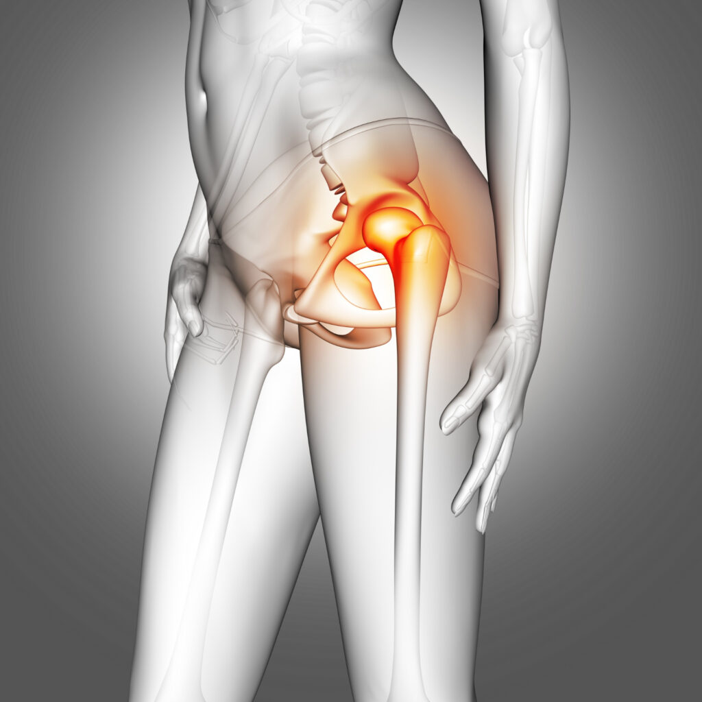 Hip replacement surgery