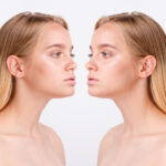 Uneven Nostrils After Rhinoplasty